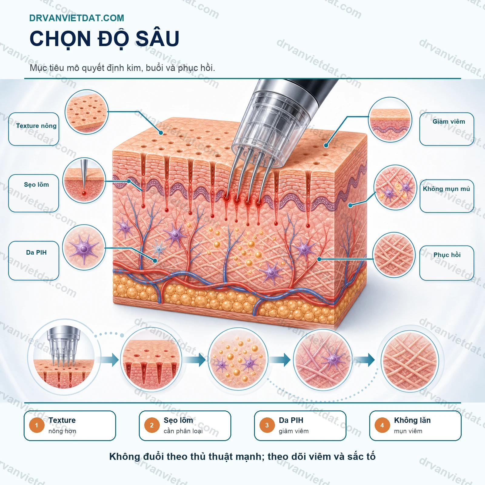 Lăn kim 2: Lăn kim vi điểm và tái tạo collagen - chọn độ sâu, khoảng cách và chỉ định