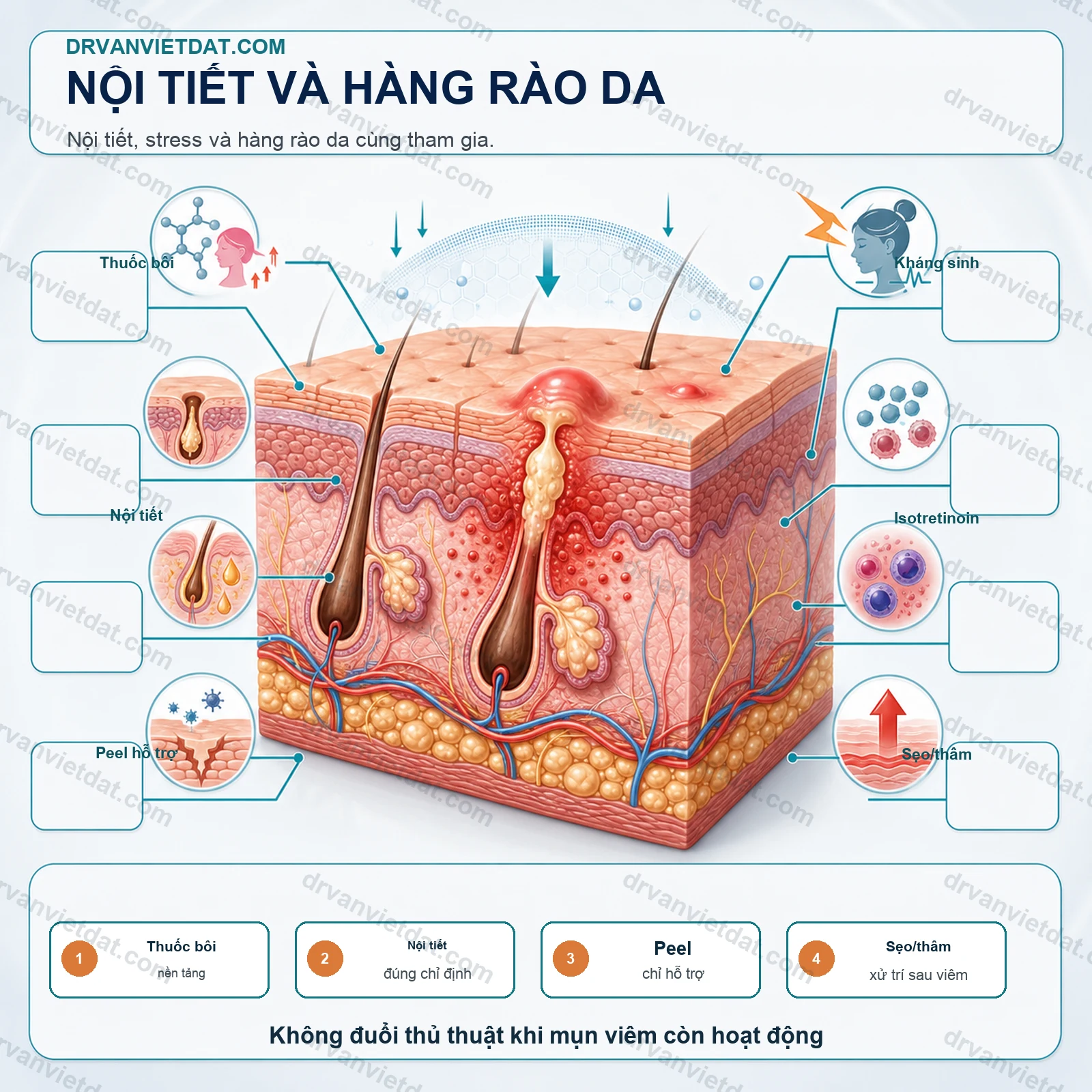 Mụn phụ nữ trưởng thành 1: Vai trò nội tiết, stress và hàng rào da - cơ chế