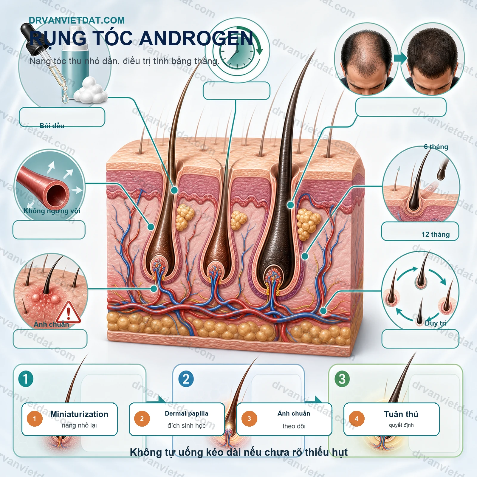 Minoxidil trong rụng tóc androgen: dùng sao cho đúng và kiên trì đủ lâu?