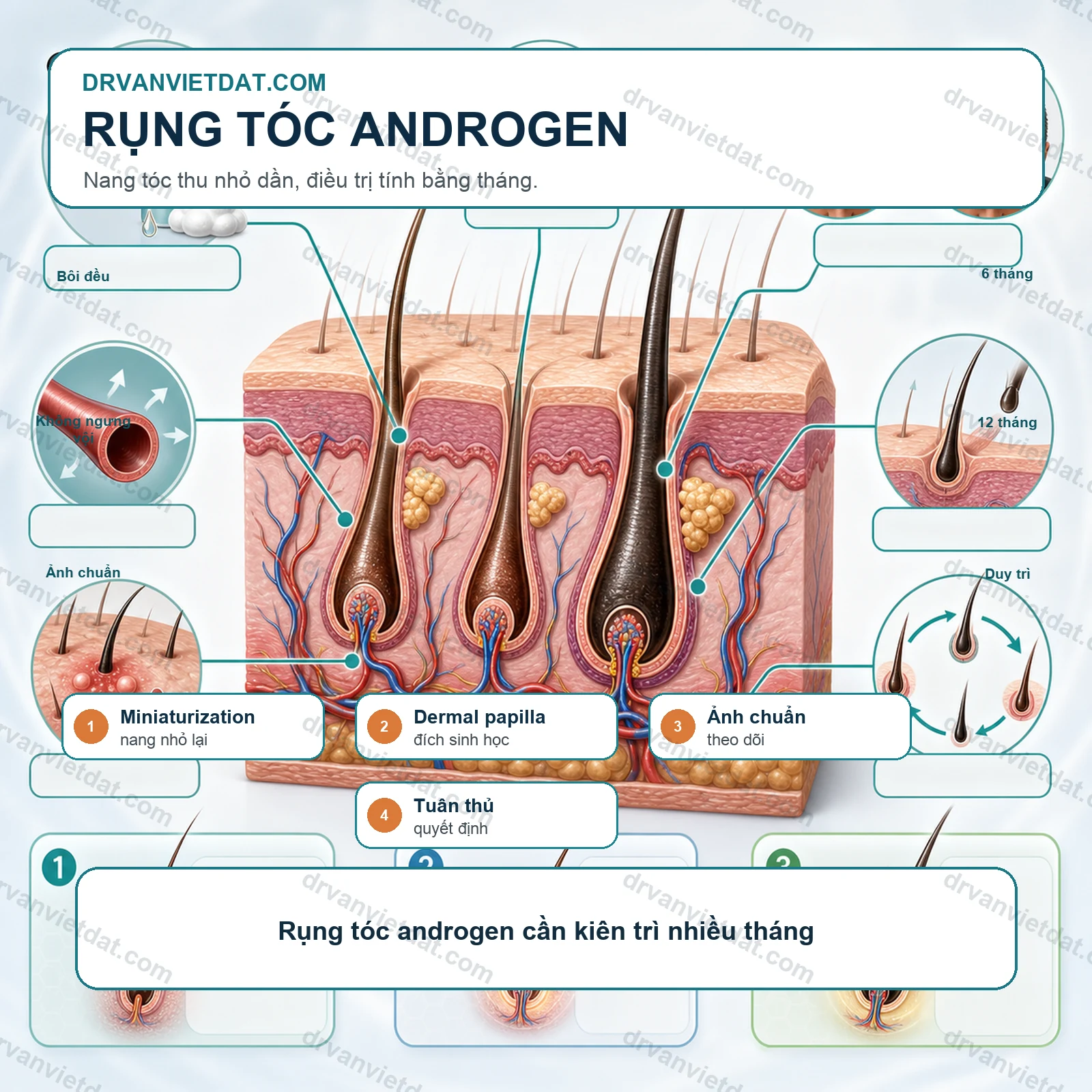 Minoxidil trong rụng tóc androgen: dùng sao cho đúng và kiên trì đủ lâu?