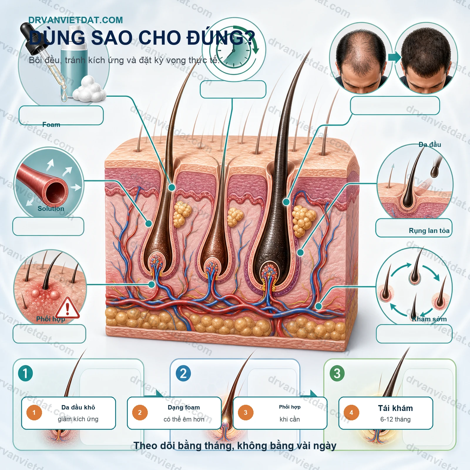 Minoxidil trong rụng tóc androgen: dùng sao cho đúng và kiên trì đủ lâu?