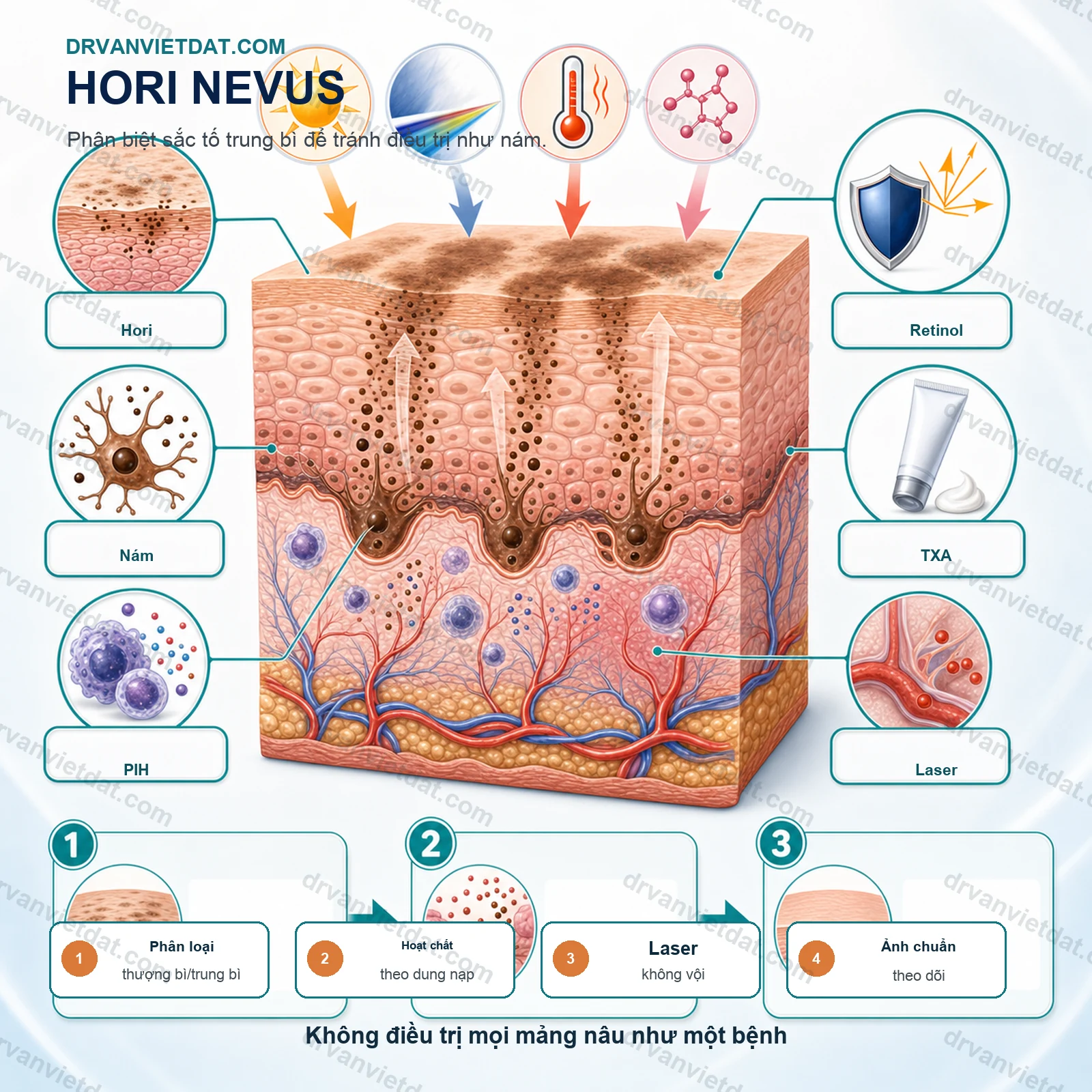 Hori nevus và nám: phân biệt đúng để tránh điều trị sai hướng