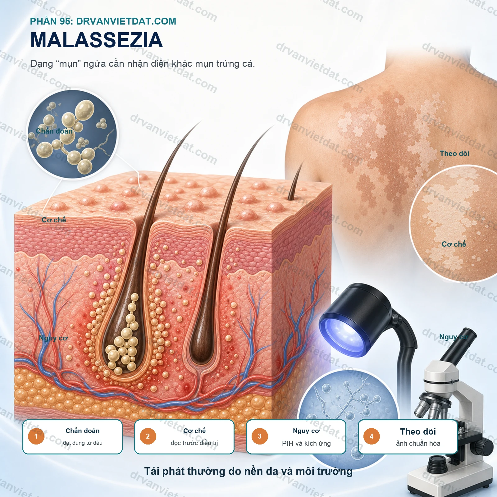 Phần 95: Viêm nang lông do Malassezia: dạng “mụn” ngứa dễ bị điều trị nhầm