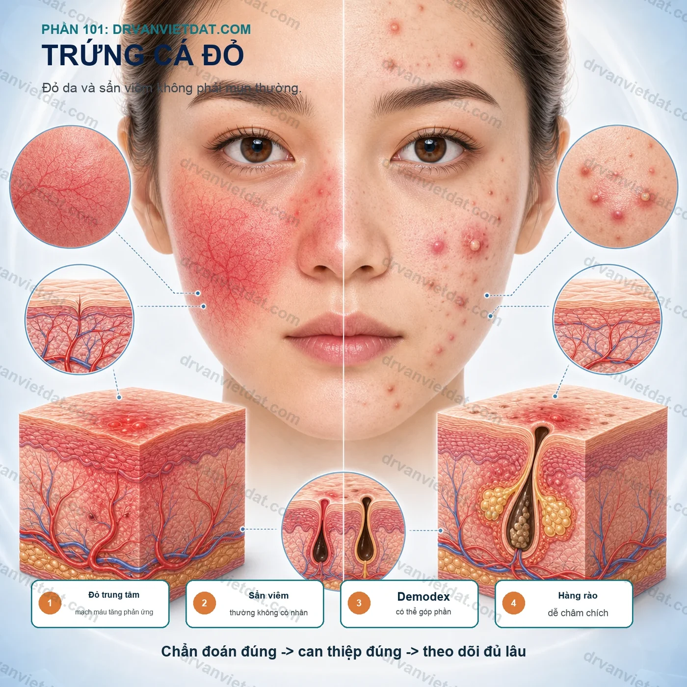 Phần 101: Trứng cá đỏ: điều trị đỏ da và sẩn viêm khác gì mụn thông thường?