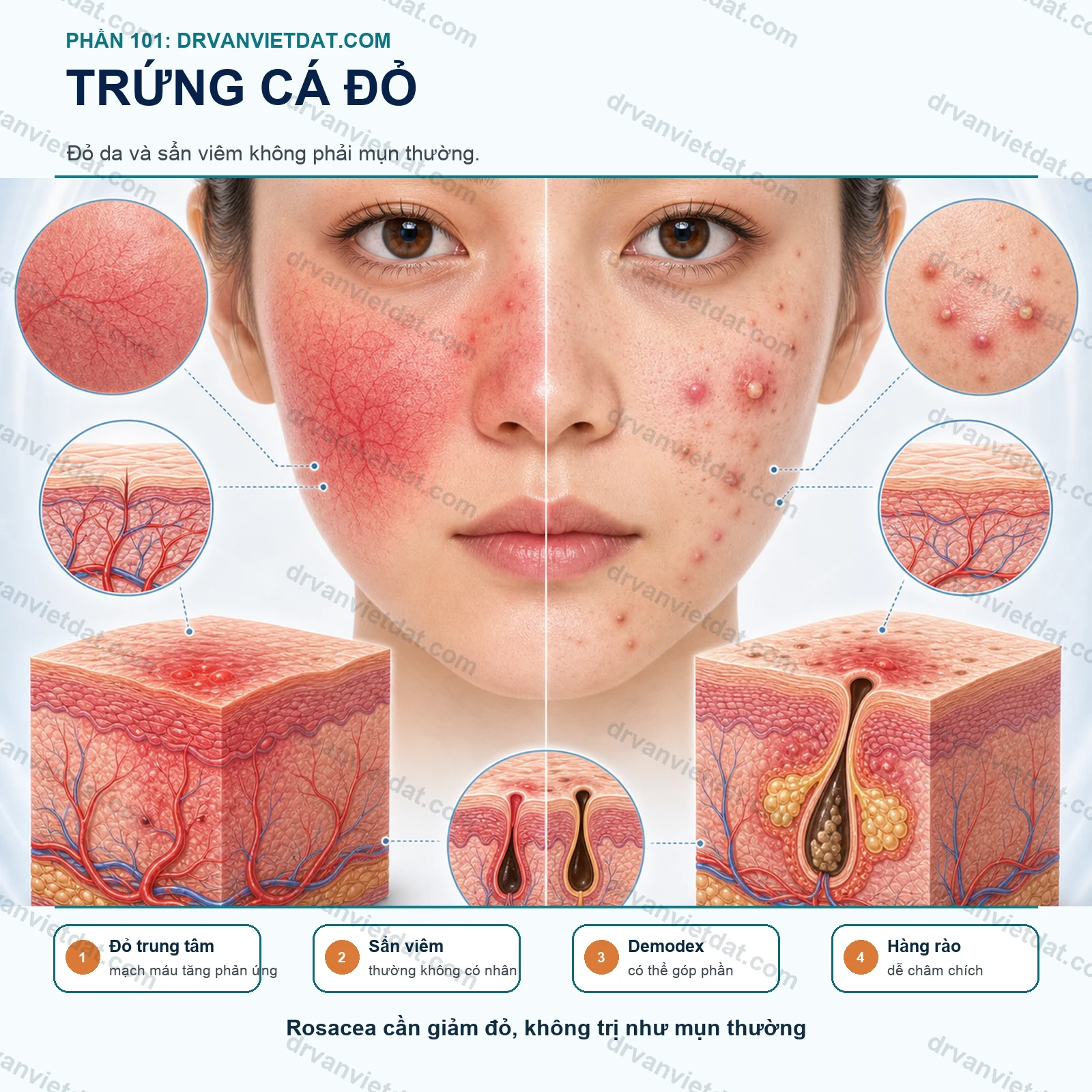Phần 101: Trứng cá đỏ: điều trị đỏ da và sẩn viêm khác gì mụn thông thường?