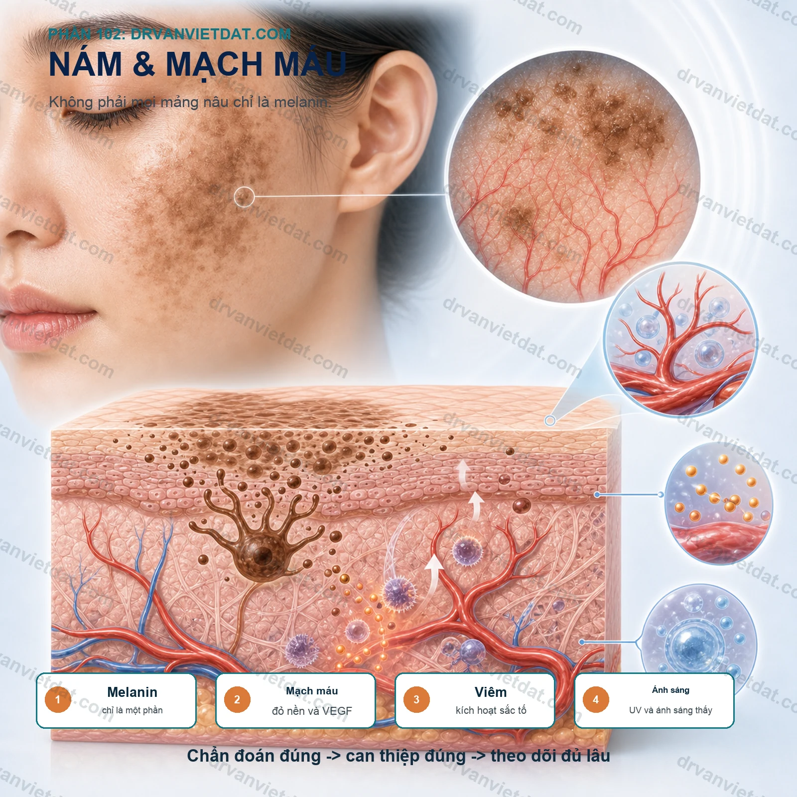 Phần 102: Nám có yếu tố mạch máu: vì sao điều trị chỉ nhắm melanin là chưa đủ?