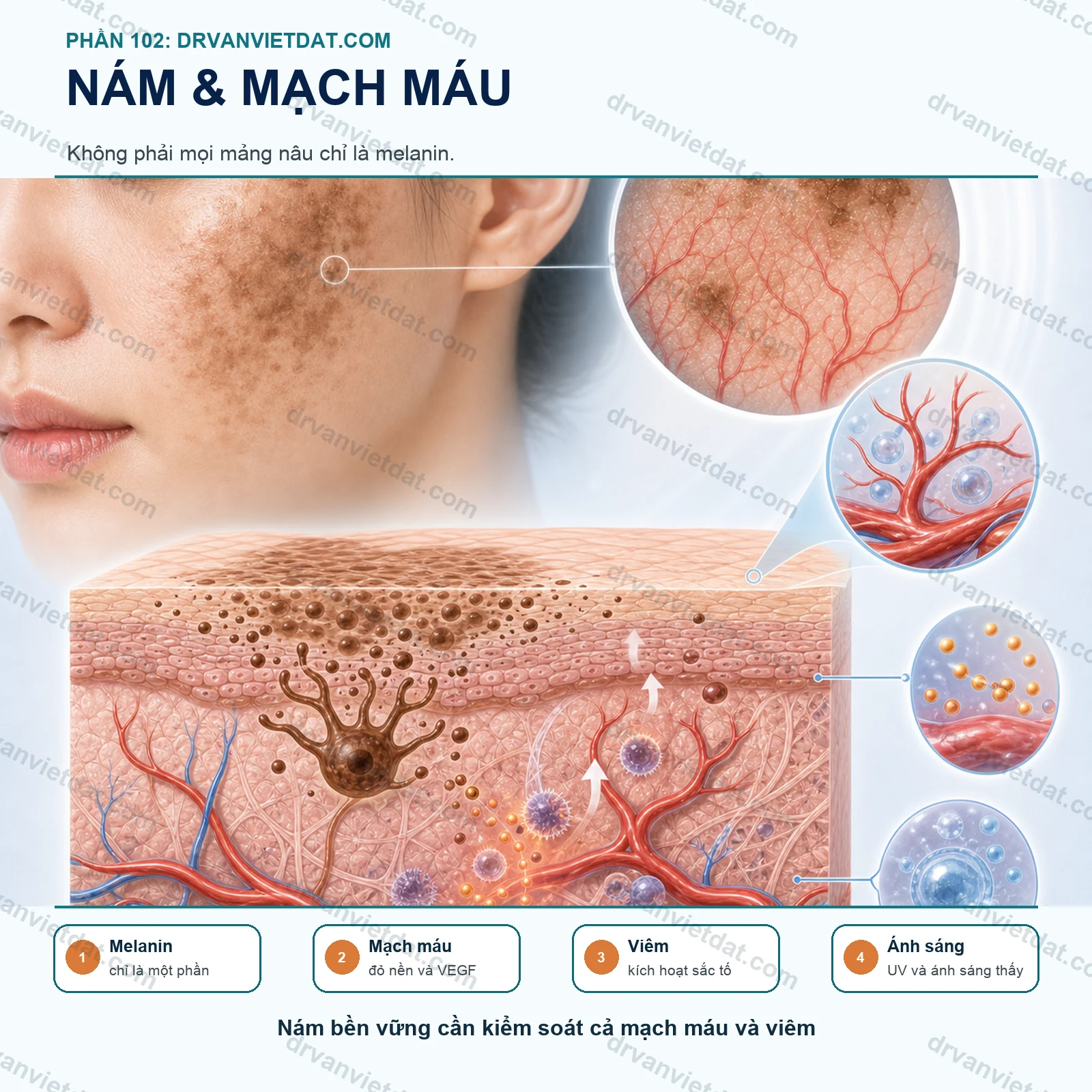 Phần 102: Nám có yếu tố mạch máu: vì sao điều trị chỉ nhắm melanin là chưa đủ?