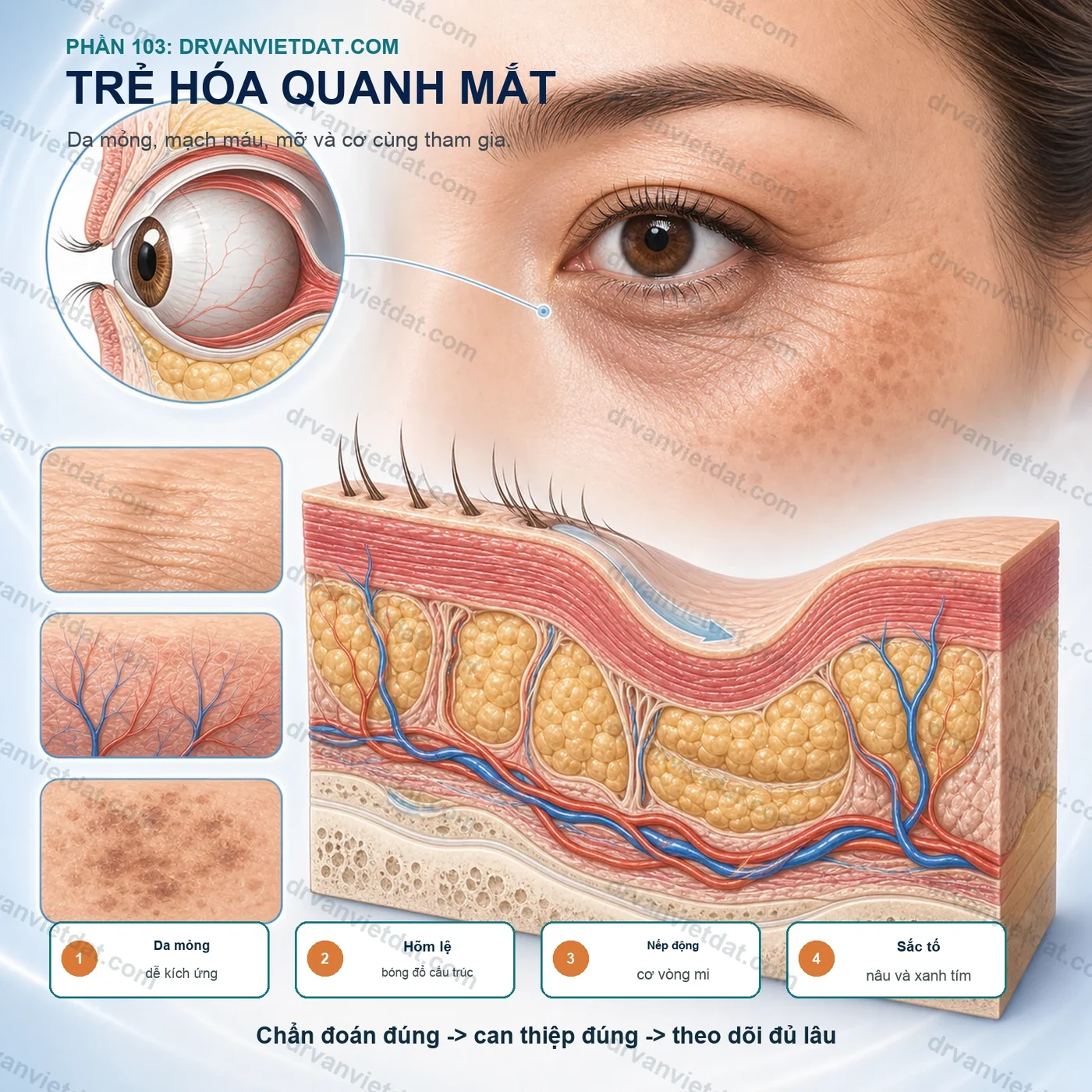 Phần 103: Trẻ hóa vùng quanh mắt: vì sao cần phối hợp nhiều phương pháp?