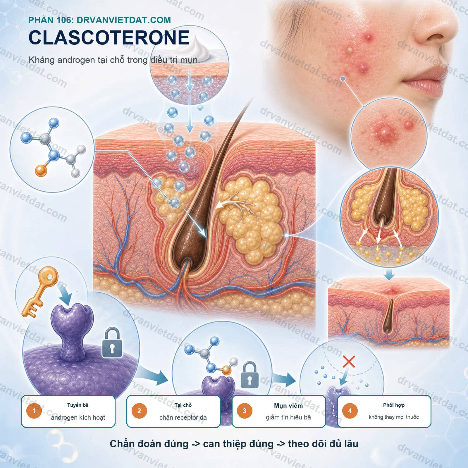 Phần 106: Clascoterone bôi trị mụn: kháng androgen tại chỗ có gì mới?