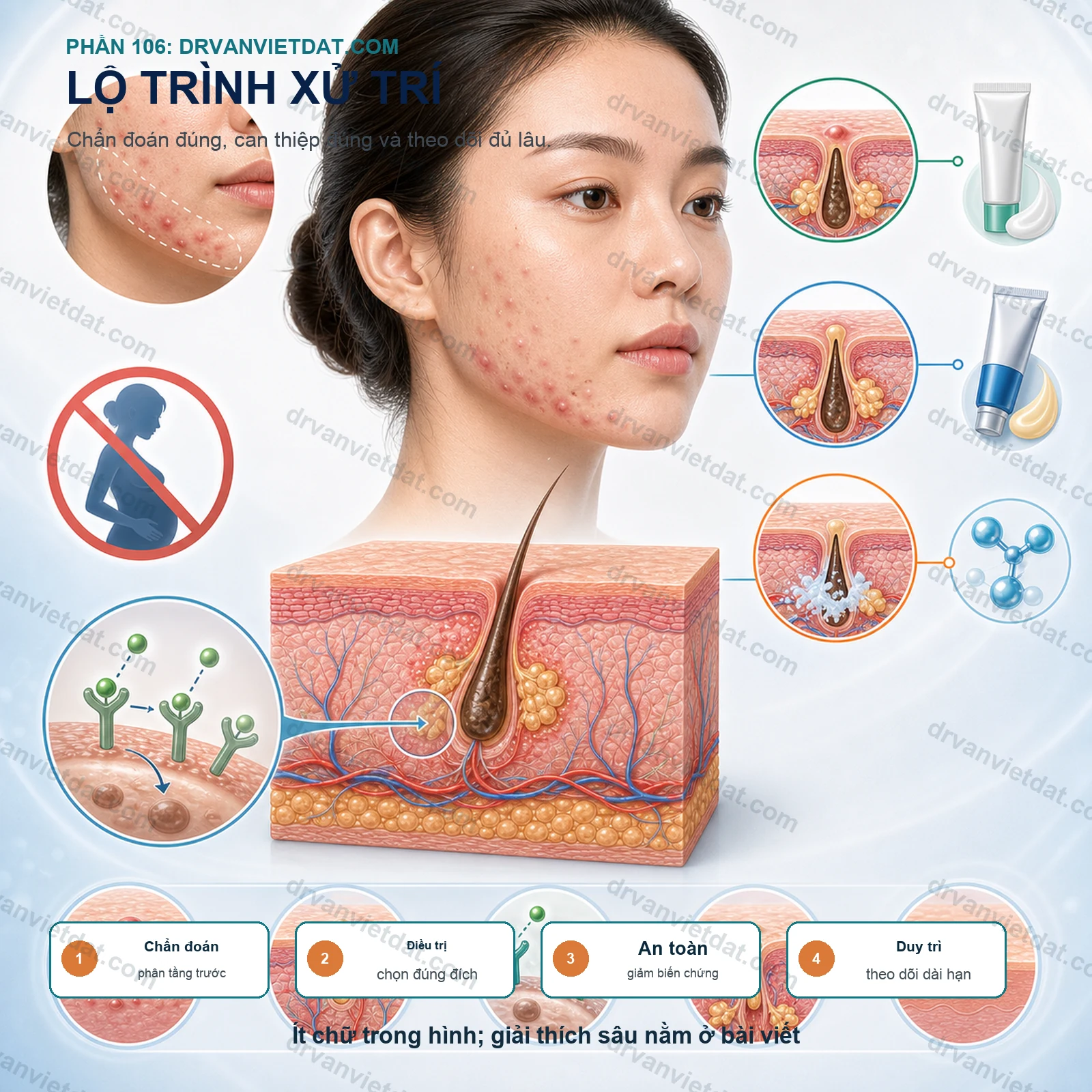 Phần 106: Clascoterone bôi trị mụn: kháng androgen tại chỗ có gì mới?