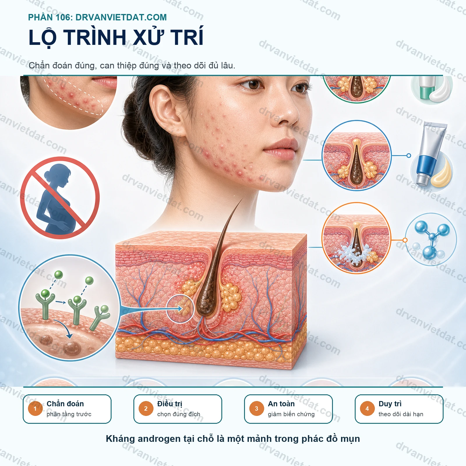 Phần 106: Clascoterone bôi trị mụn: kháng androgen tại chỗ có gì mới?