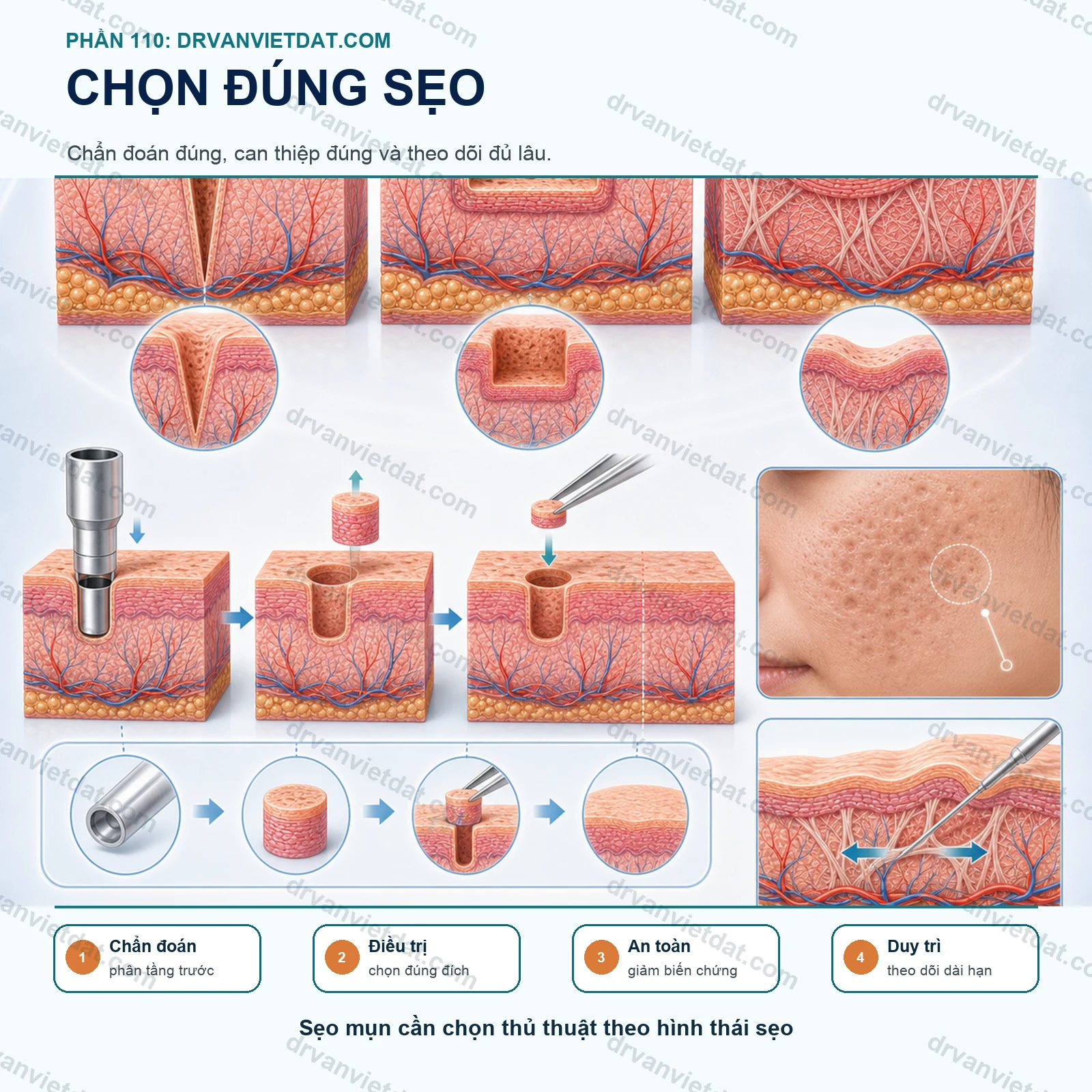 Phần 110: Cắt đáy sẹo, punch và ghép da trong sẹo mụn: chọn đúng sẹo mới có kết quả (phần chọn bệnh nhân)