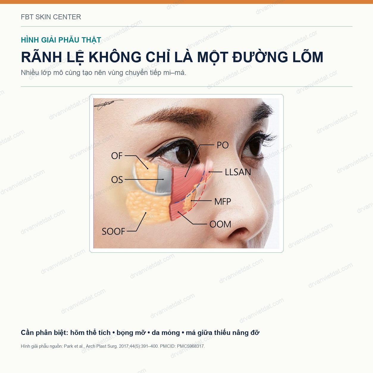 Filler rãnh lệ: vì sao vùng dưới mắt dễ đẹp giả, sưng và lộ filler?