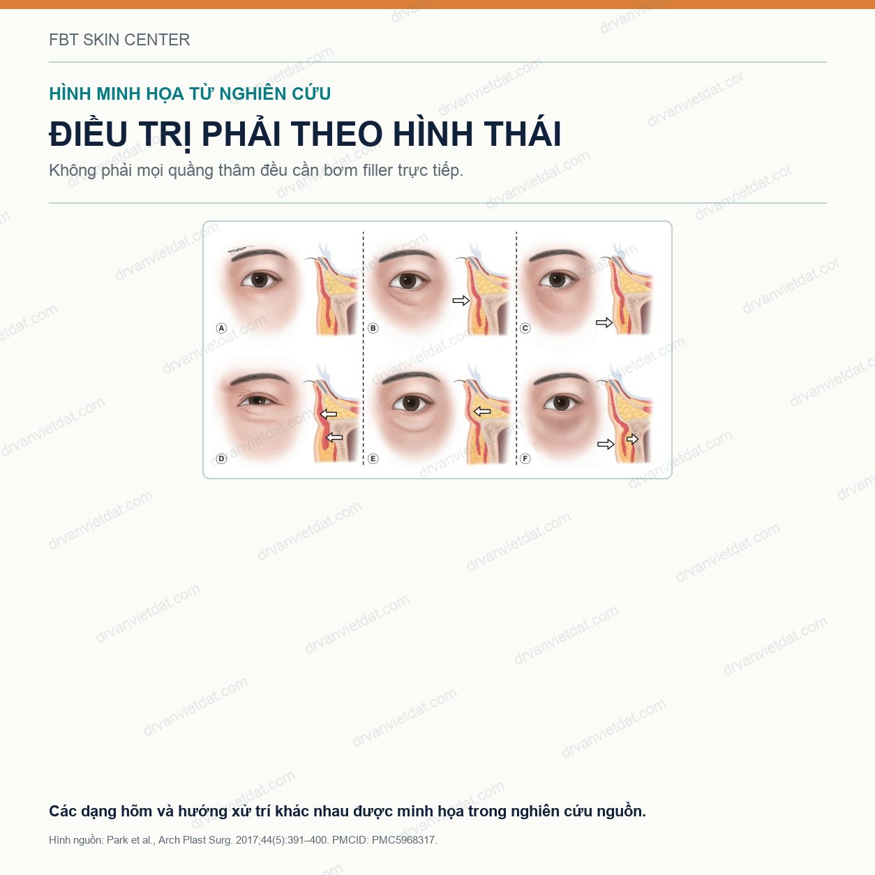 Filler rãnh lệ: vì sao vùng dưới mắt dễ đẹp giả, sưng và lộ filler?