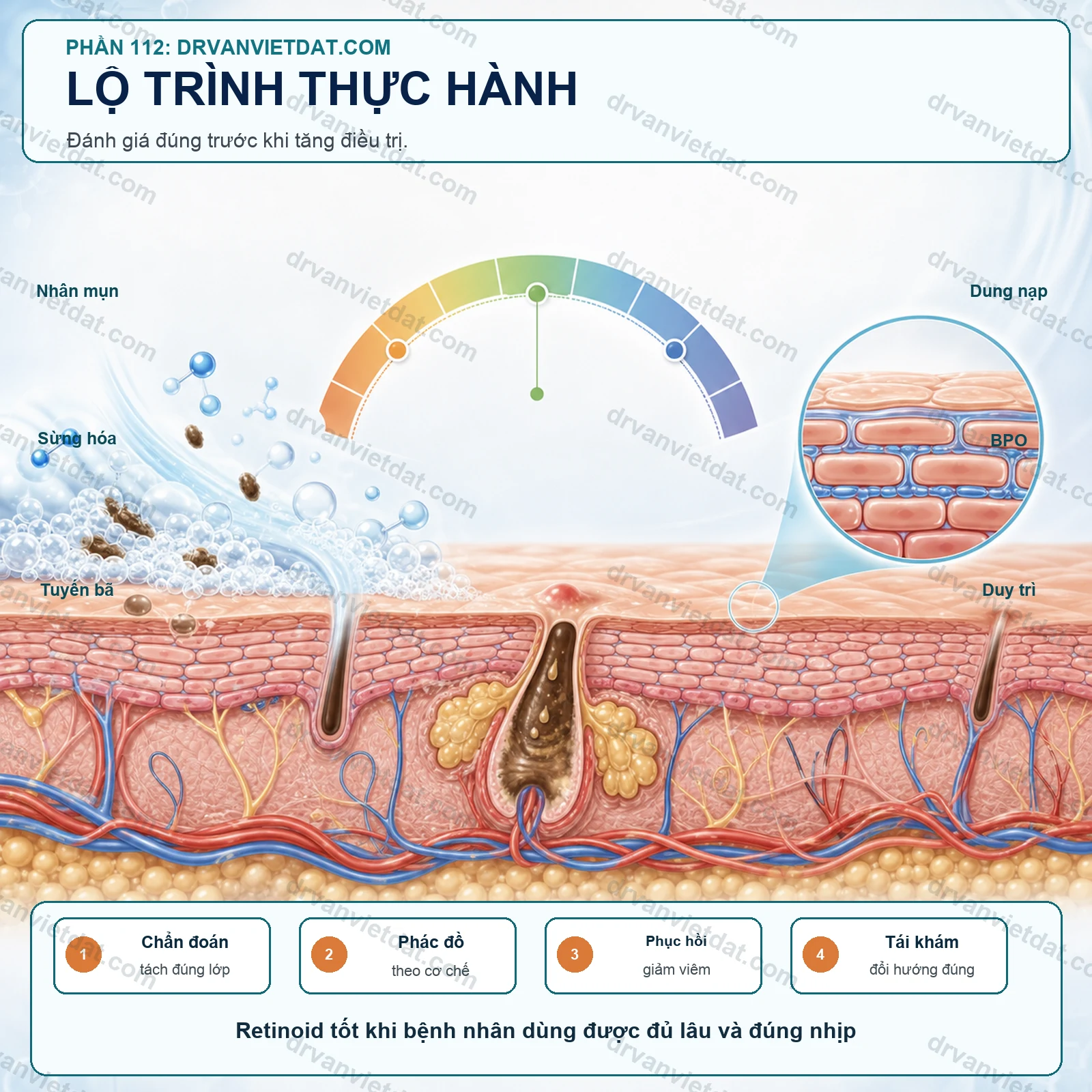 Adapalene và tretinoin: chọn retinoid trị mụn theo nền da nào?