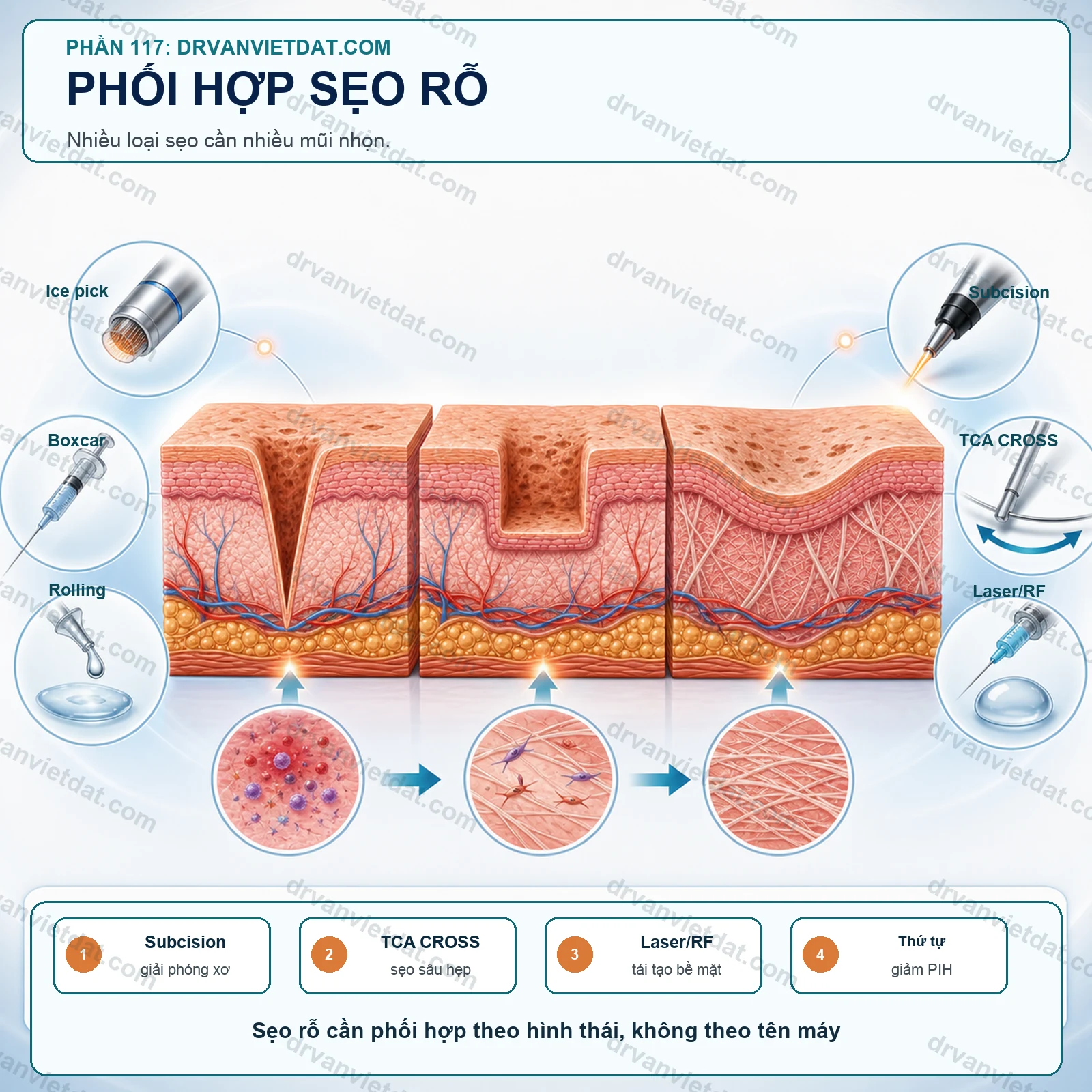 Phối hợp subcision, TCA CROSS và laser fractional trong sẹo rỗ: vì sao cần nhiều mũi nhọn?