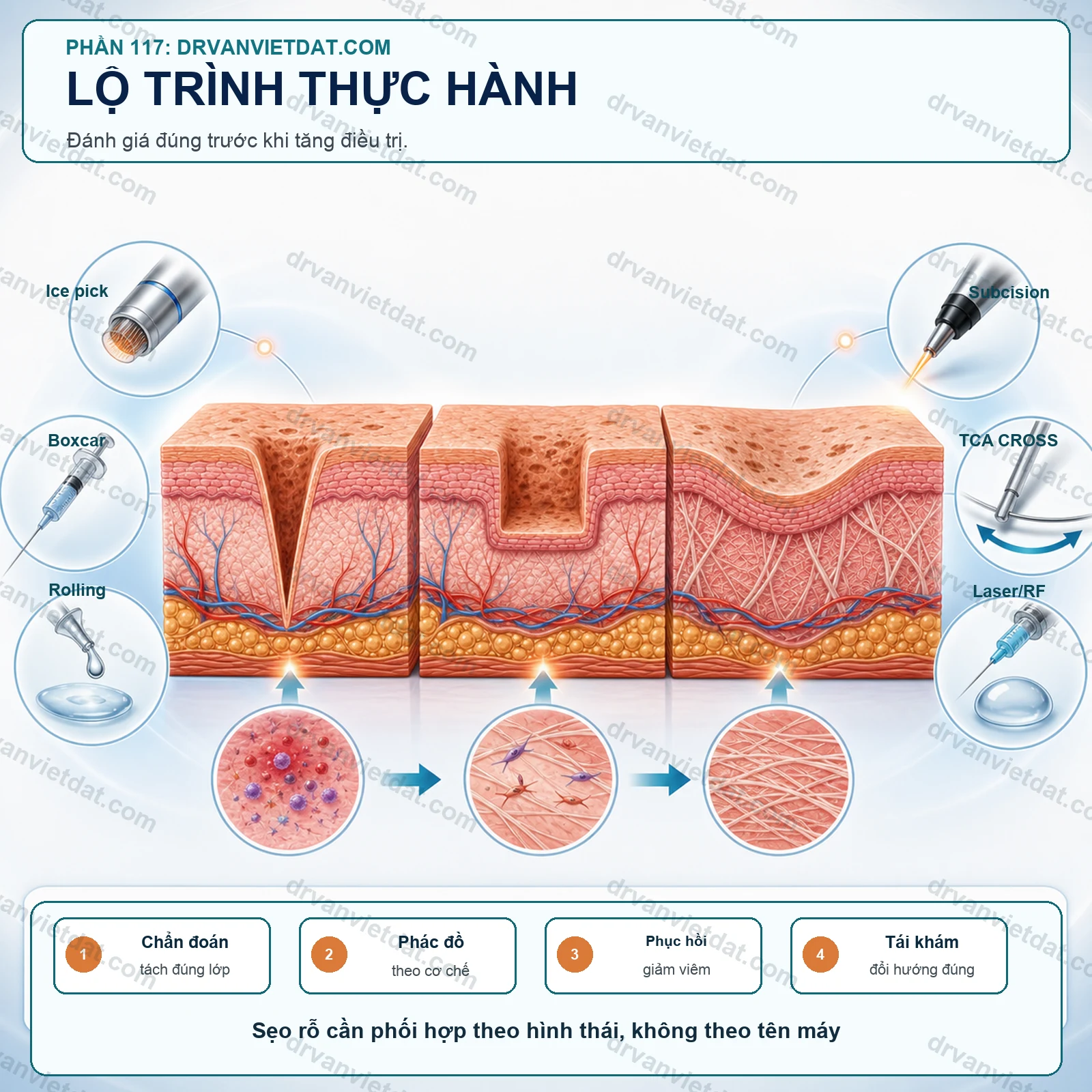 Phối hợp subcision, TCA CROSS và laser fractional trong sẹo rỗ: vì sao cần nhiều mũi nhọn?