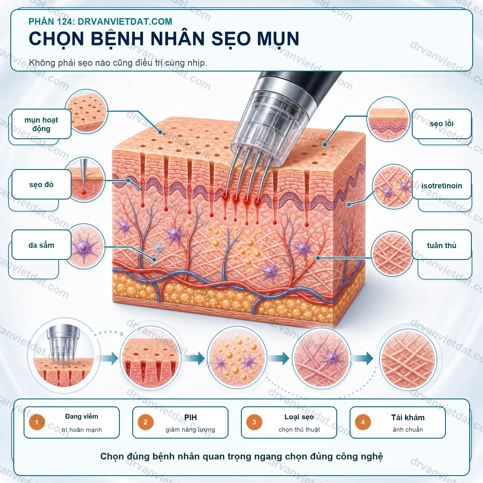 Phần 124: Sẹo rỗ: chọn bệnh nhân trước khi chọn subcision, TCA CROSS hay laser