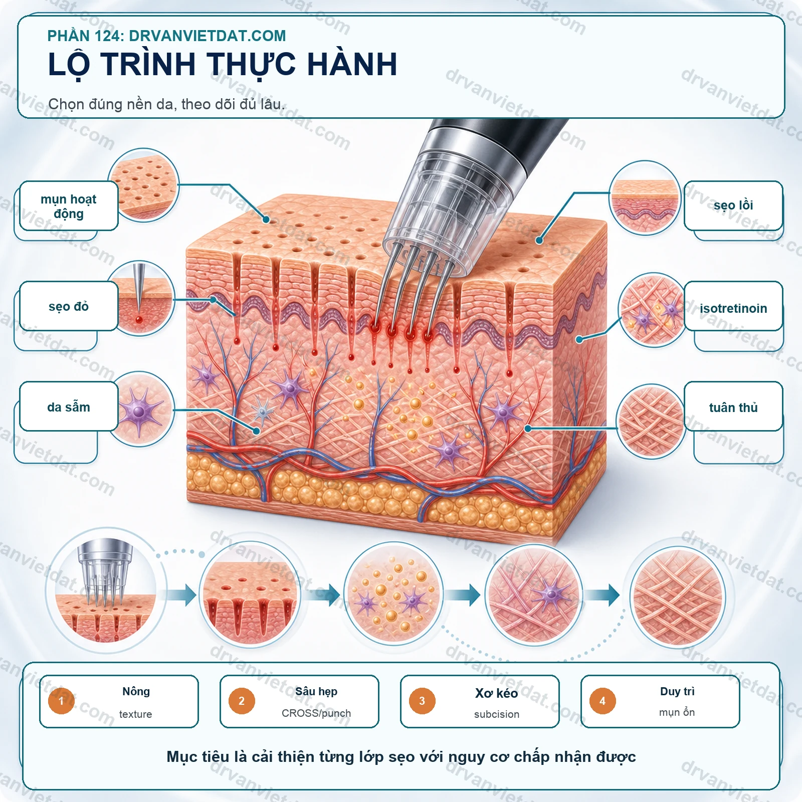 Phần 124: Sẹo rỗ: chọn bệnh nhân trước khi chọn subcision, TCA CROSS hay laser