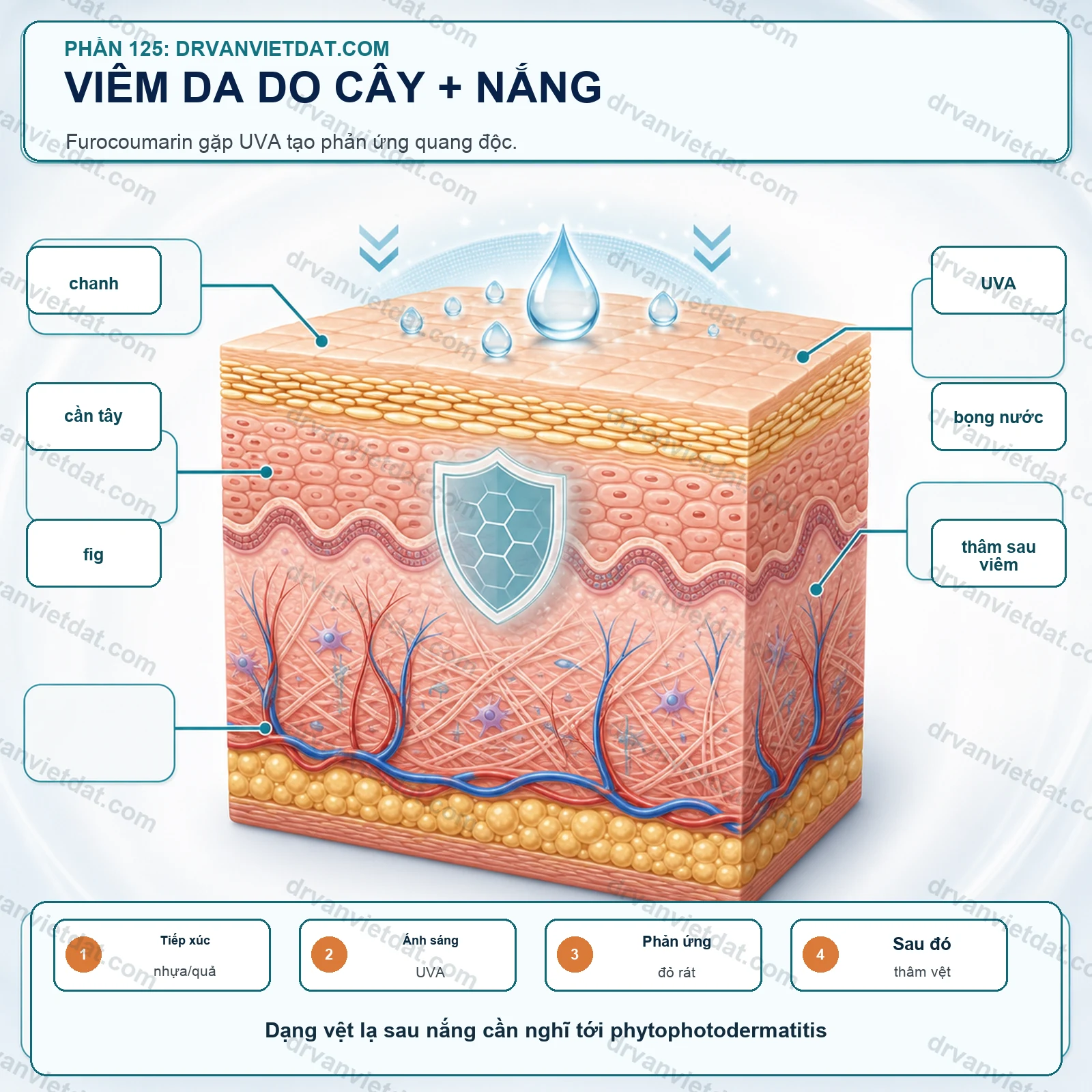 Phần 125: Viêm da tiếp xúc ánh sáng do thực vật: vệt thâm sau nắng dễ bị bỏ sót