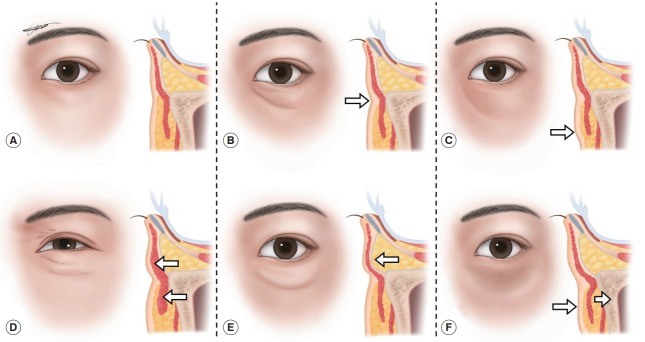 Filler rãnh lệ: hình thái vùng quanh ổ mắt