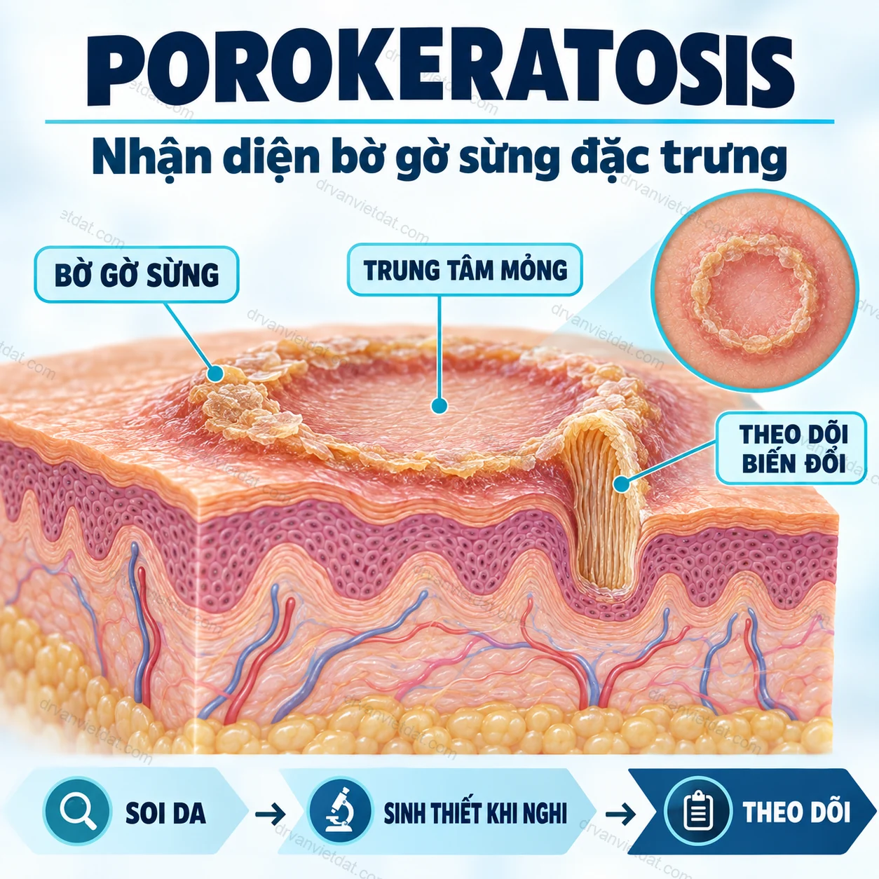 Infographic: Porokeratosis: nhận diện tổn thương vòng và lý do cần theo dõi