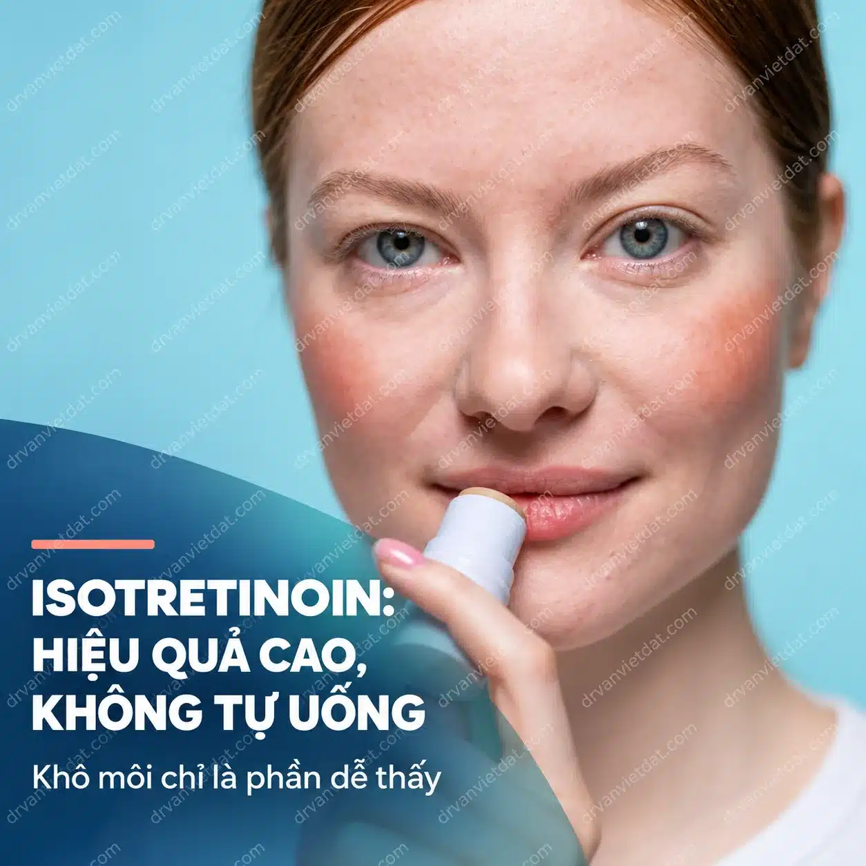 Hình minh họa chăm sóc môi và da khô khi điều trị isotretinoin