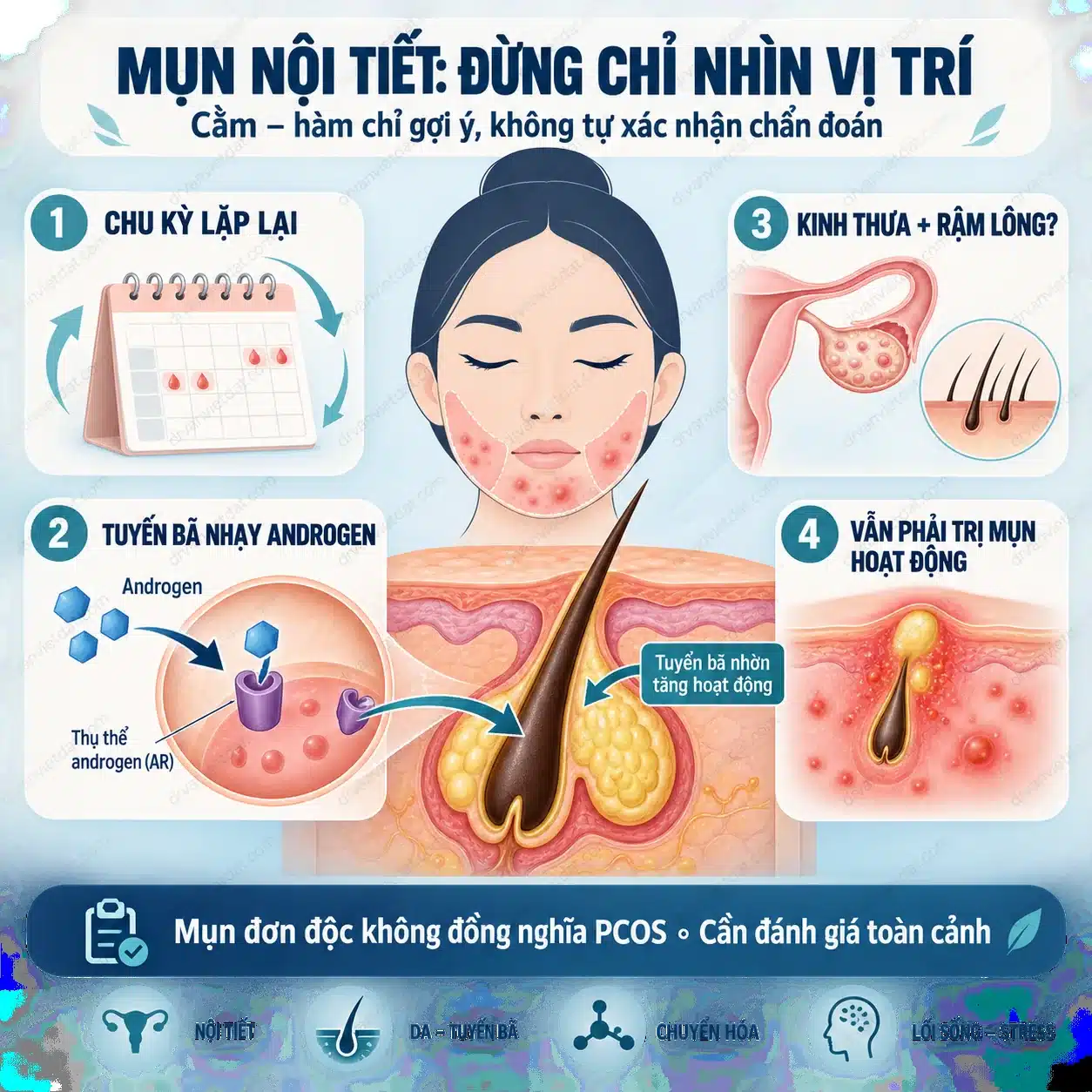 Infographic mối liên hệ androgen tuyến bã bít tắc và mụn nội tiết ở người lớn